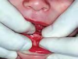 תינוק בן 4 ימים בבדיקה במרפאת השיניים לילדים, המרכז הרפואי ע"ש שיבא עקב ממצא של Natal Tooth חבלה לשיניים החותכות הראשוניות - גיל 14 חודשים עששת הבקבוק - Decay Baby Bottle Tooth עקב הרגל שתיית בקבוק