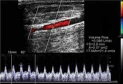 Značaj dupleks ultrasonografije arteriovenske fistule Arterio-venska fistula se kreira operativnim spajanjem vene i arterije, najčešće ruke.