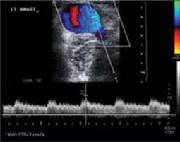 Ultrazvuk vaskularnog pristupa se koristi u sledeće 4 oblasti: 1. Preoperativni maping 2. Praćenje maturacije 3. Određivanje mesta punkcije 4.