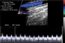 Preoperativni maping podrazumeva ultrazvučni pregled arterija i vena ruke radi procene pogodnosti za kreiranje vaskularnog pristupa.