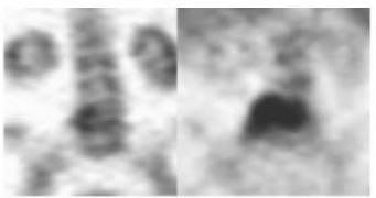 Σπινθηρογράφημα Technetium scan Gallium scan (Αυξημένη πρόσληψη στο Ο4-Ο5 επίπεδο)