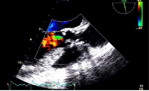 Valvular and Supravalvular Aortic Stenosis