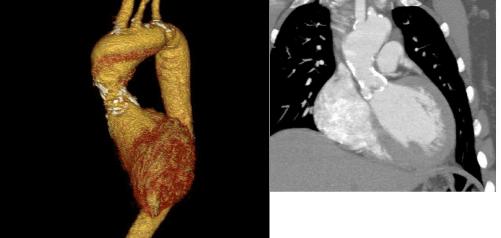 report of a 46 year old female pt with FH (J