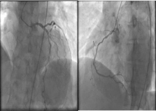 supravalvular aortic stenosis MDCT image of