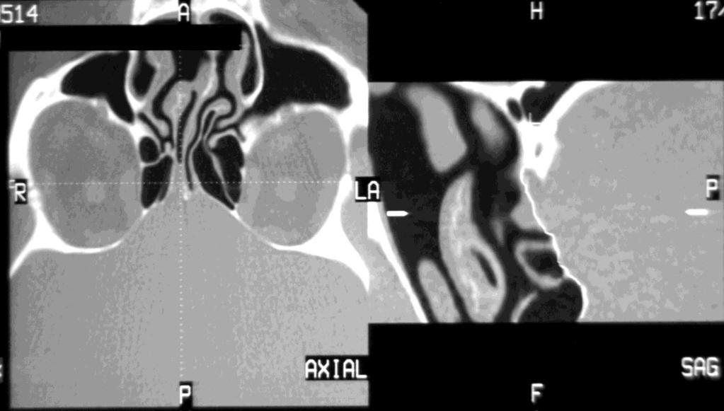 (α) (β) Εικόνα 5: Αξονική τομογραφία βάσεως κρανίου και σπλαχνικού κρανίου (α:εγκάρσια τομή και
