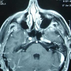 Εικόνα 10: Ασθενής με αυτόματη ρινόρροια ΕΝΥ.