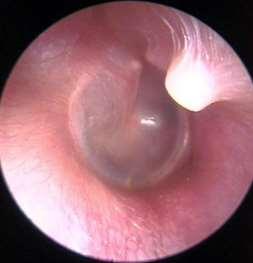 ΤΥΜΠΑΝΙΚΟΣ ΥΜΕΝΑΣ 2 σφύρα άκμονας αναβολέας Ο τυμπανικός υμένας εκτείνεται στο τέλος του έξω ακουστικού πόρου, το οποίο και αποφράσσει.