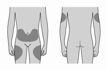 Unde trebuie să faceţi injecţia? Cele mai bune locuri pentru injecţie sunt partea de sus a coapselor şi abdomenul.