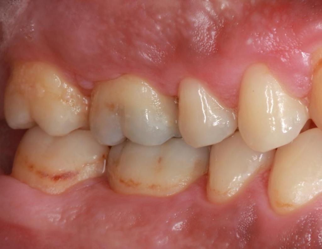 Σχηματισμός Οδοντικής Μικροβιακής Πλάκας (ΟΜΠ) Μαλακή μη ενασβεστιωμένη άθροιση μικροοργανισμών και των