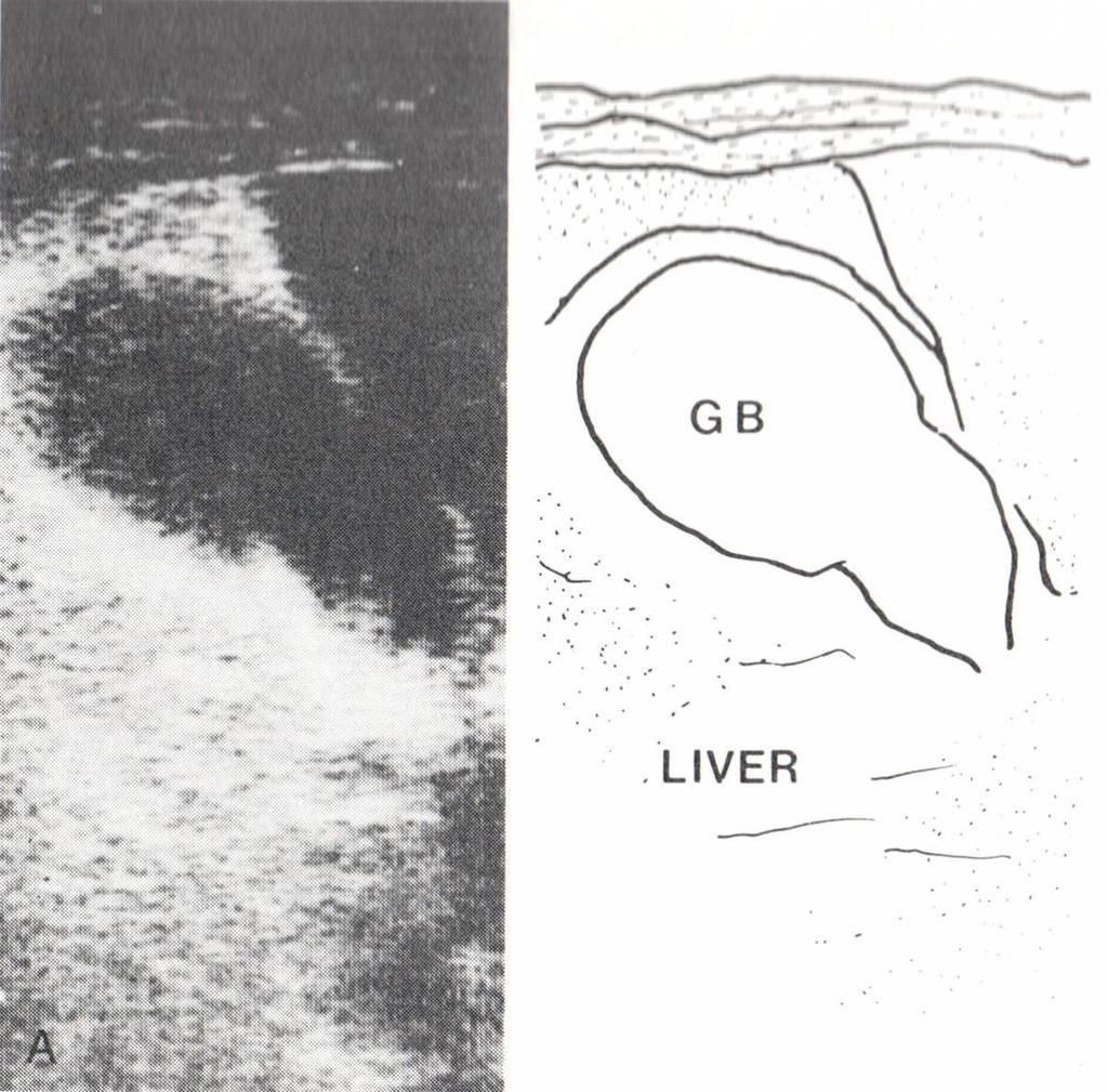 Chemoterapija: Prazikvantelis,