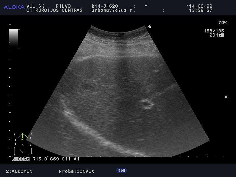 Kepenų sonoskopija : kepenų darinys, dif. Abscesas, tumoras.