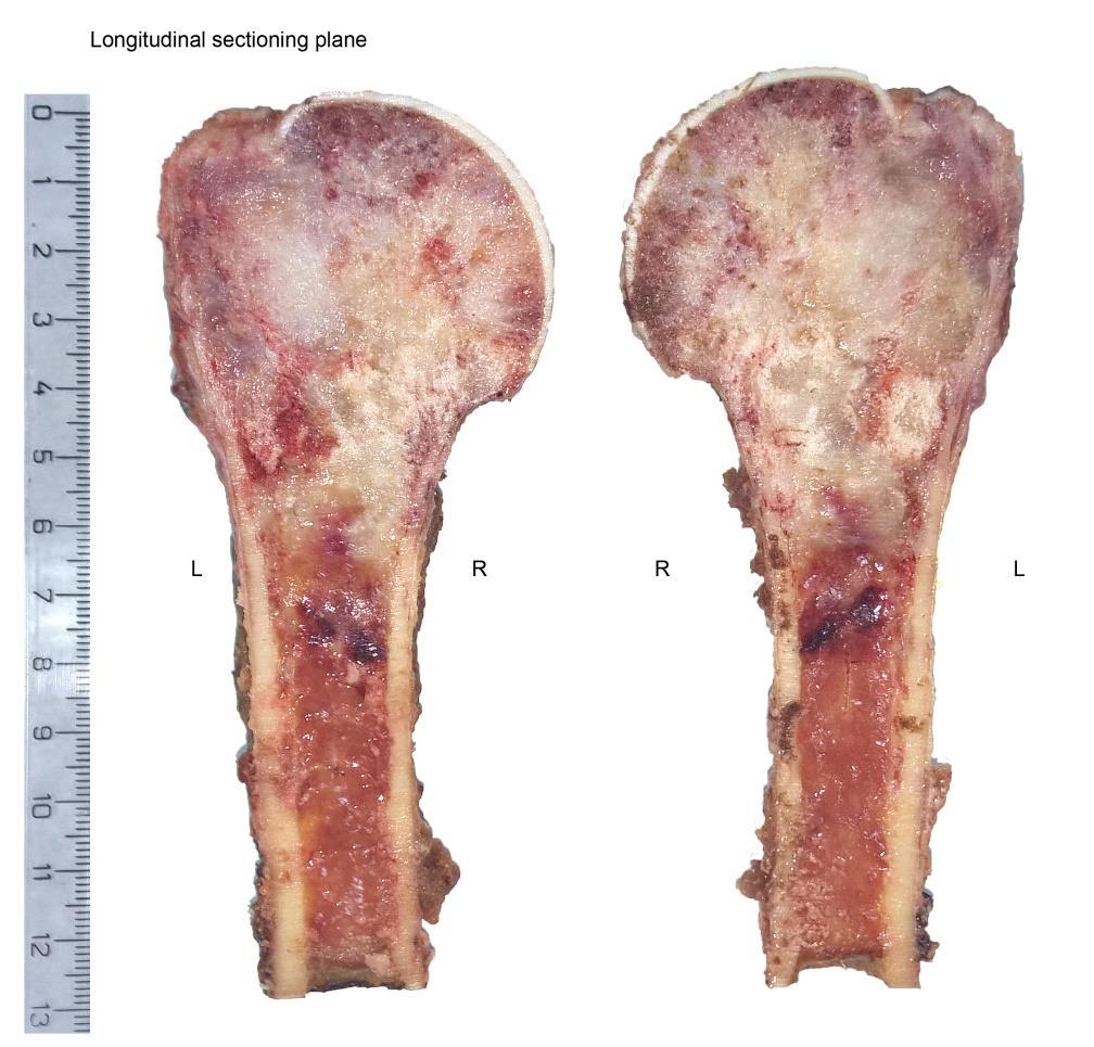 1Β. Οστεοβλαστικοί όγκοι - οστεοσάρκωμα μακροσκοπική