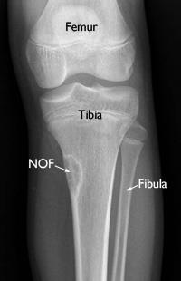 του οστού ή BFH (benign fibrous histiocytoma) όταν εντοπίζεται στην πύελο Ηλικία: παιδική και εφηβική.