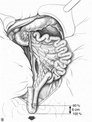 Πληρης ανατομική κινητοποίηση εντέρου Εκτίμηση μήκους μεσεντερίου (εκ.