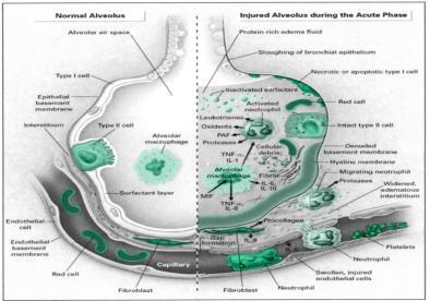 Sinh ly bệnh Acide dịch vị ngăn sự phát triển của vi khuẩn trong bình thường Dịch vị có thể nơi cư trú của vi khuẩn gram (- ) ở BN xử dụng antacid hay nuôi ăn bằng sonde dạ dày, liệt dạ dày, tắc nghe