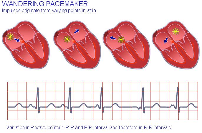 Wandering pacemaker Stimulul fiziologic este situat în zona sinusului coronar Modificare gradată a undei P, de la un aspect pozitiv spre unul negativ şi invers Originea sinusală a undei P