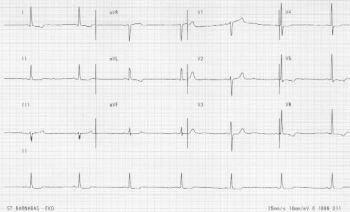 Lasīt elektrokardiogrammu RR intervāls - ilgums starp diviem sirdspukstiem.