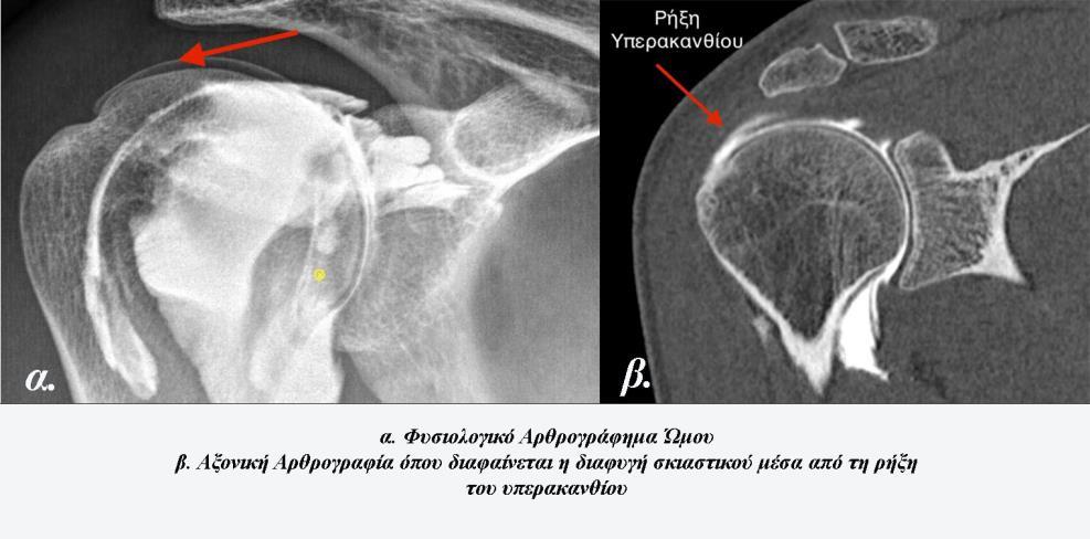 την ακριβή διάγνωση, χαρτογράφηση, μέτρηση και χαρακτηρισμό των ρήξεων με ευαισθησία 94-100% (για πλήρεις ρήξεις) και 93-96% (για μερικές ρήξεις) [7].