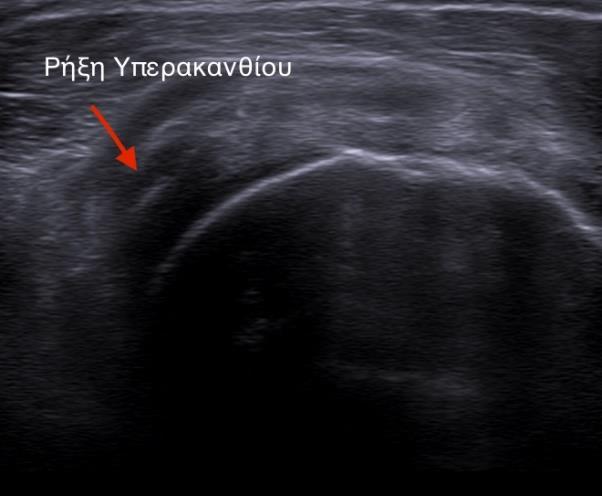8: Υπερηχογραφική εικόνα πλήρους ρήξεως του υπερακανθίου o Στις ολικού πάχους ρήξεις του τένοντα του υπερακάνθιου, η υπερηχογραφία και MRI έχουν ανάλογες επιδόσεις.