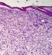 وأحد جزئات الحمض الوو الطولة غر الم شف رة )lncrna( تمث ل مت سخ ا غر مع لج إزم سم ى»وبكو ت كاربوكسترمال هدرولز ل 1 -«أو )Uchl1( شارك ف وظائف الدماغ ومتورط ف شوء الت ك س العصب.