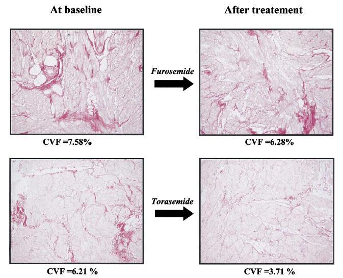 Effects of Loop Diuretics on Myocardial Fibrosis and Collagen Type I Turnover in CHF Pts with NYHA functional class II to IV CHF received either 10-20 mg/day oral torasemide (n =19) or 20 to 40