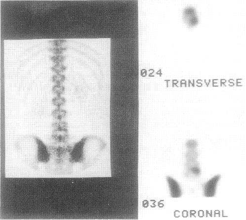 SPECT και SPECT/CT Οι παρϊμετροι απεικόνιςησ θα πρϋπει να βαςύζονται ςτισ ςυςτϊςεισ του καταςκευαςτό.