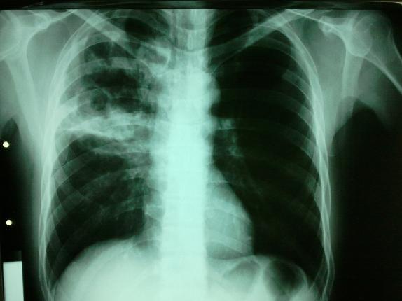 dureri articulare cu tuberculom)