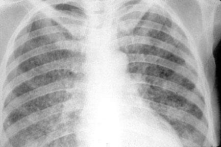 Tuberculoza (TBC) - Ce este, Simptome si Tratament