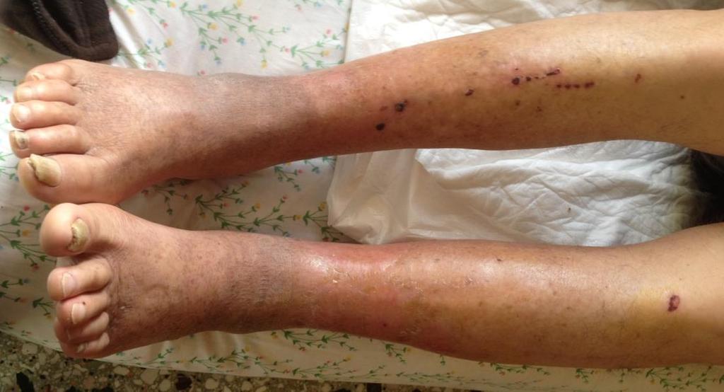 Ειδική Επισκόπηση Κλινική Εξέταση Αυτόνομο Νευρικό Σύστημα - Ξηροδερμία, απολέπιση 1. Λογοθέτης Ι, Μυλωνάς Ι.