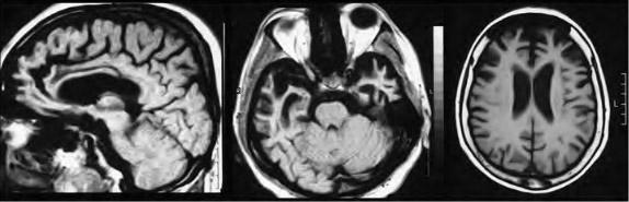 Τ-1 weighted απεικόνιση μαγνητικής τομογραφίας (εγκάρσια, οβελιαία) οι οποίες καταδεικνύουν ατροφία του μετωπιαίου και κροταφικού λοβού σε μια περίπτωση σοβαρού υπότυπου μετωποκροταφικής εκφύλισης