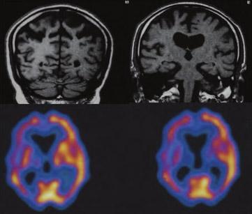 Εικόνα 4 T-1 MRI εικόνες (στεφανιαίες τομές) και εικόνες υπολογιστικής αξονικής τομογραφίας εκπομπής μονήρους φωτονίου (SPECT) σε ασθενή με φλοιοβασική εκφύλιση.