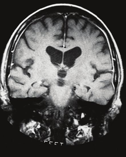 Μηνιγγίτιδα MRI απεικόνιση με σκιαστικό Gd-DTPA Διαφορική διάγνωση ΕΝΥ βακτηριακής/ιογενούς μηνιγγίτιδας Βακτηριακή Ιογενής Πίεση 200-500 mmh 2 O <250 mmh 2 O Κύτταρα 10-10000 /mm 3