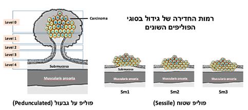 במה ביטאון לעובדי בריאות בנושא מחלת הסרטן והשלכותיה הגישה הטיפולית לפוליפ ממאיר פרופ דן אדרקה השירות לגידולי מערכת העיכול, המערך האונקולוגי, המרכז הרפואי שיבא, תל השומר מבוא שכיחות הגידולים הממאירים