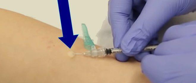 Fișa tehnică 11 Injecția intradermică Definiţie Introducerea strict intradermic de soluţii izotone în organism, prin intermediul unui ac fin cu vârf tăiat scurt ataşat la o seringă.
