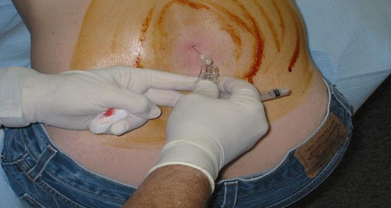 interspinos; introducerea acului se va face progresiv prin ligamentul interspinos, ligamentele galbene şi dura mater, însoţită de retragerea periodică a mandrenului pentru a verifica poziţia acului;