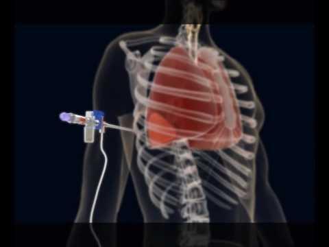 - coexistentă unui abces rece osifluent Materiale necesare: - Antiseptice: alcool iodat,betadină - Tampoane si porttampon(pensă) - seringi, ace sau trocare sterile,de unică folosinţă - anestezic