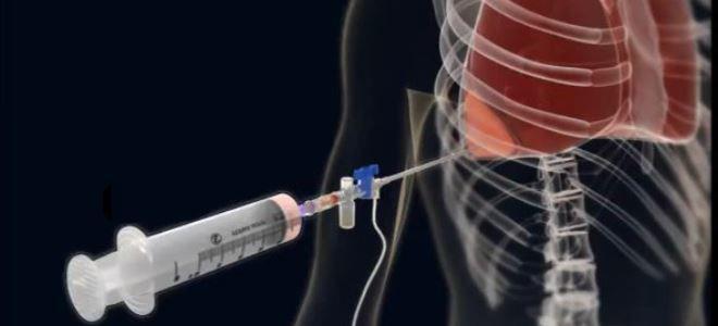dispozitiv de aspirație, - tuburi de dren, recipient colector, - comprese sterile și leucoplast Loc de puncție: în colecțiilor libere din pleură puncție în spatiul VIII intercostal pe linia axilară