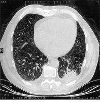Zygomycosis Πνετμόνψν Οτδεσεποπενικοί Μη ειδικά