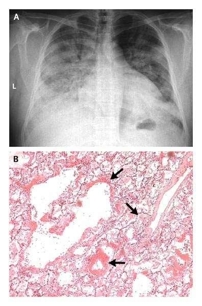 Πνετμονία από H1N1v Διάφτσα διηθήμασα - patchy pneumonia Νέκπψςη σοιφώμασορ βπογφιολίψν