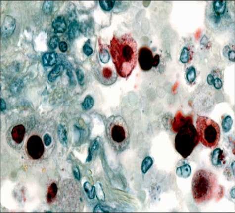 Influenza pneumonitis Immunolocalisation of 2009 pandemic influenza H1N1 viral antigen in lung tissue
