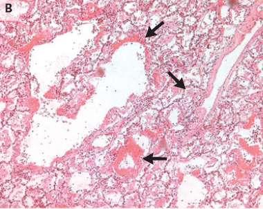 Lesions of the respiratory system Necrosis of bronchiolar walls Neutrophilic infiltrate