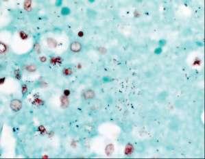 Streptococcus pneumoniae ςε αςθενή με 2009 pandemic influenza A (H1N1) Gram (+) κόκκοι σεφνική Lillie- Twort Gram