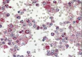 pneumoniae σεφνική immunoalkaline phosphatase με naphthol-fast red και hematoxylin CDC = δείγμασα απο νεκποχίερ :