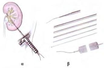 Διδακτορική Διατριβή 24 Εικόνα 2.6. α. Προώθηση στη νεφρική πύελο δεύτερου συρμάτινου οδηγού και διάνοιξη της απονεύρωσης με το ειδικό μαχαιρίδιο β.