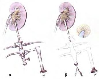 Τοποθέτηση θήκης Amplatz και προώθηση του νεφροσκοπίου στη νεφρική πύελο β.