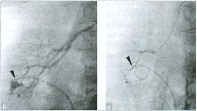 Διδακτορική Διατριβή 42 Εικόνα 2.14 δ,ε. Εκλεκτική αρτηριογραφία της δεξιάς νεφρικής αρτηρίας: Ψευδοανεύρυσμα κλάδου της νεφρικής αρτηρίας μετά από διαδερμική νεφρολιθοτριψία. ε.