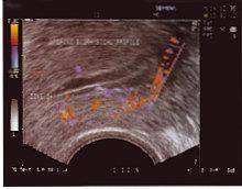 Πιο συγκεκριμένα είναι μια εξειδικευμένη υπερηχογραφική εξέταση της μήτρας του ενδομητρίου και των ωοθηκών γίνεται με ειδικά μηχανήματα υπερήχων TRIPLEX (όπως της καρδιάς και των αγγείων) και