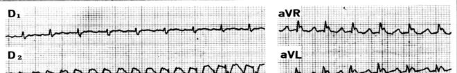 V. Flutter atrial Tahicardie atrială regulată şi monomorfă cu frecvenţa de 220-320 pe minut, asociată unui ritm ventricular