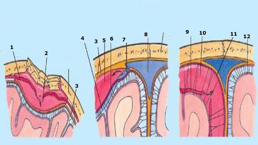 1. Μζςθ μθνιγγικι αρτθρία 2. Επιςκλθρίδιο αιμάτωμα 3. κλθρά μινιγγα 4. Φλζβα 5. Τποςκλθρίδιο αιμάτωμα 6. Αραχνοειδισ μινιγγα 7.