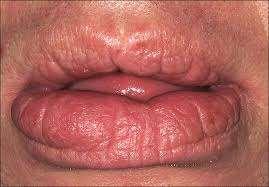 Κοκκιωματώδης χειλίτιδα (χαρακτηριστική αλλά μη ειδική) Υποξεία, τμηματική, κοκκιωματώδης φλεγμονή του κάτω χείλους Υποτροπιάζων οίδημα που μεταπίπτει σε μόνιμη διήθηση με